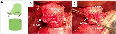 Application of cholecystic duct plasty in the prevention of biliary complications following orthotopic liver transplantation